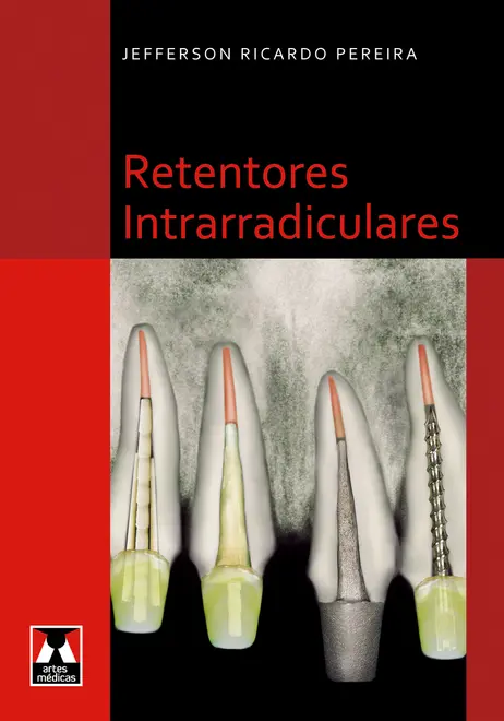 Retentores Intrarradiculares Retentores Intrarradiculares