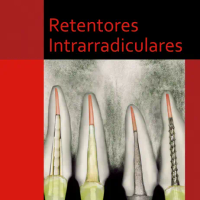 Retentores Intrarradiculares